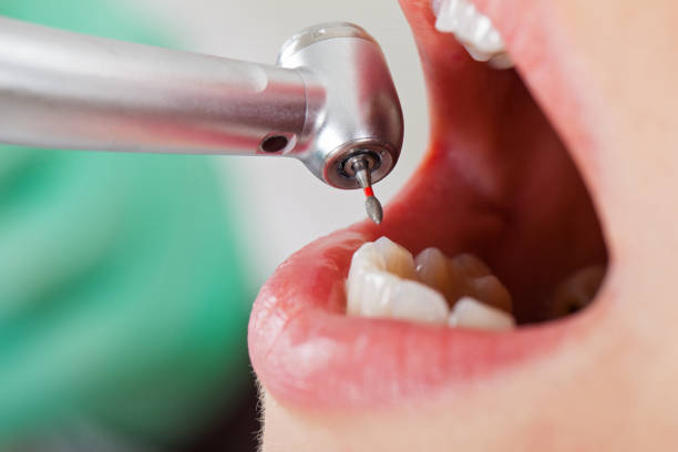 Best Emergency Tooth Extraction in Hart, TX